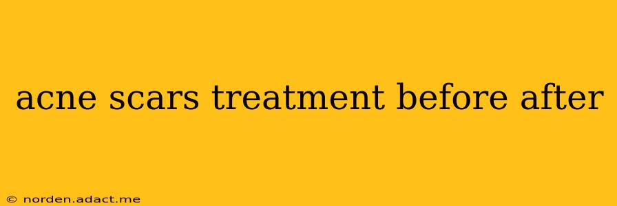 acne scars treatment before after