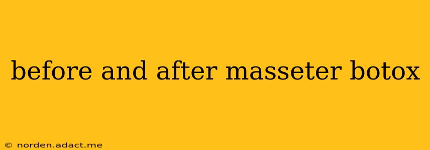 before and after masseter botox