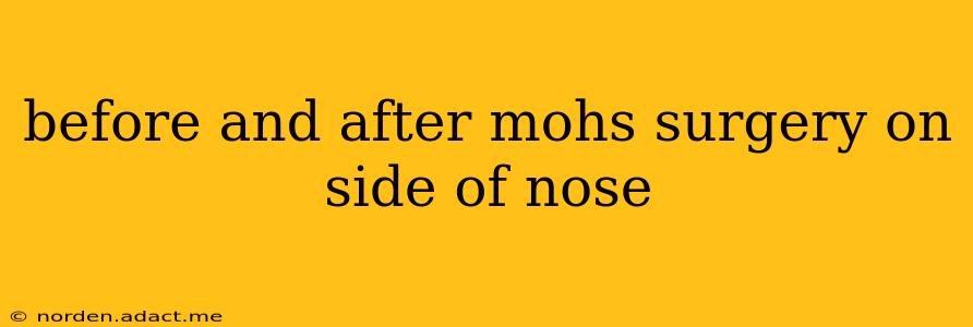 before and after mohs surgery on side of nose