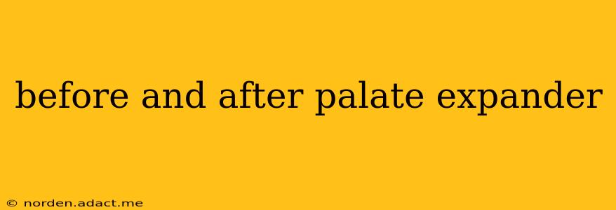 before and after palate expander