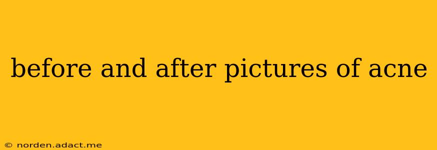 before and after pictures of acne