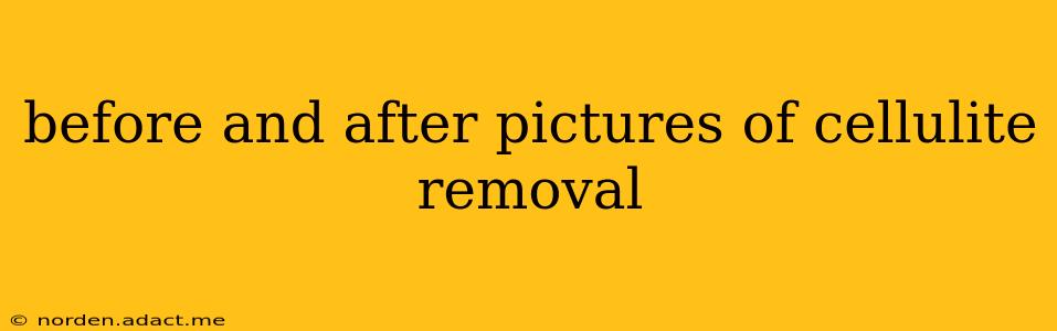 before and after pictures of cellulite removal