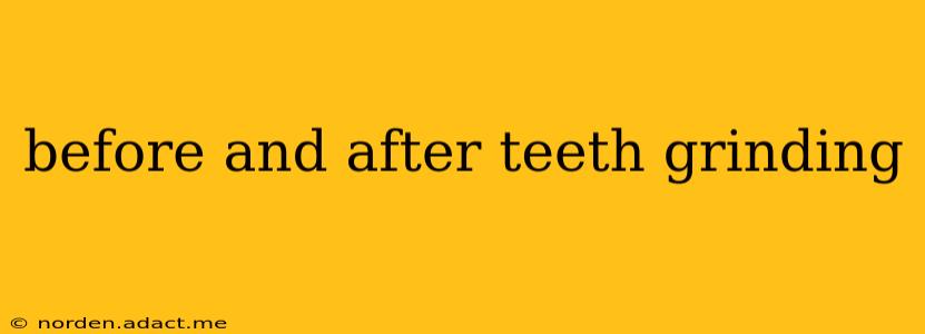 before and after teeth grinding