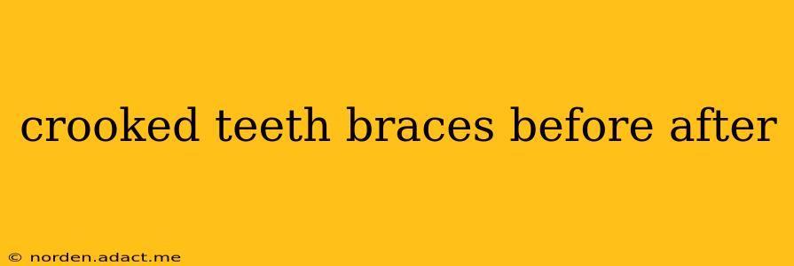 crooked teeth braces before after