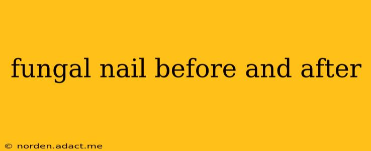 fungal nail before and after