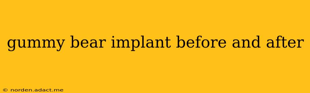 gummy bear implant before and after