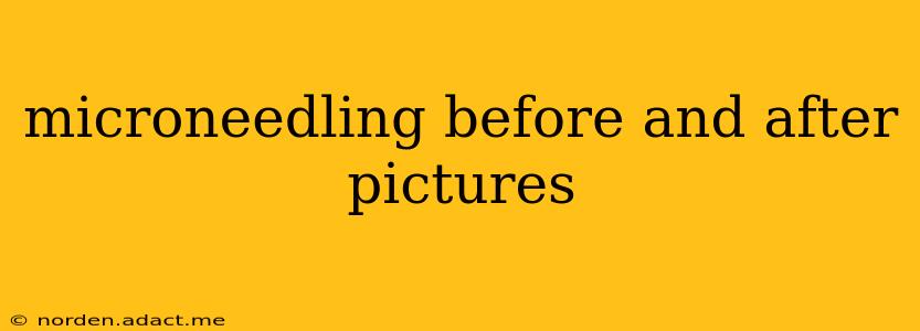microneedling before and after pictures