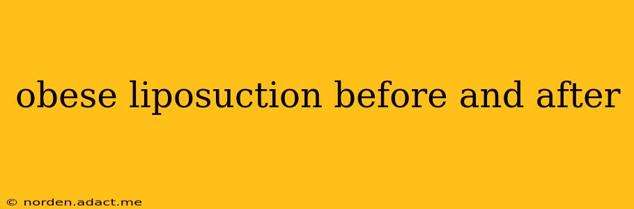 obese liposuction before and after