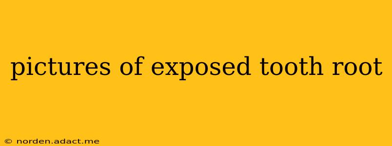 pictures of exposed tooth root