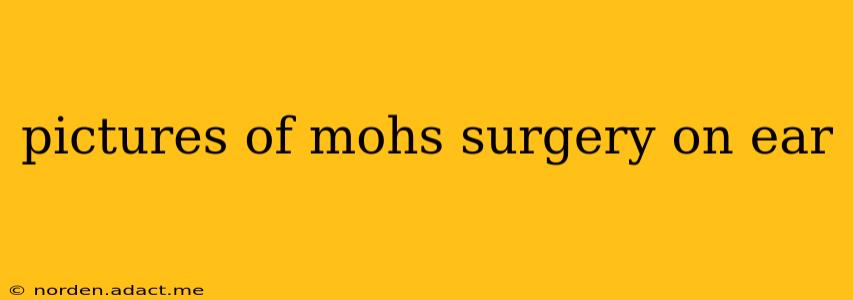 pictures of mohs surgery on ear