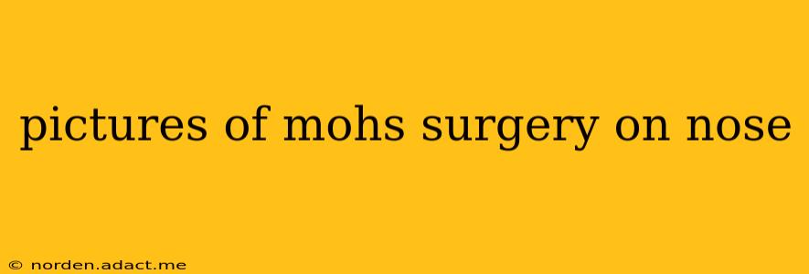 pictures of mohs surgery on nose