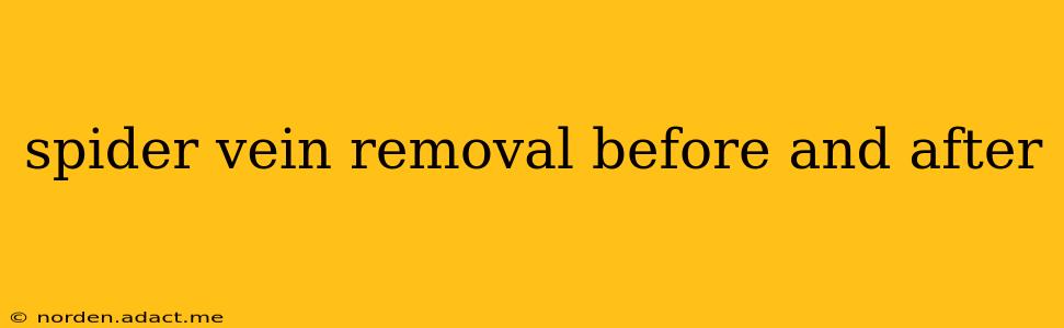 spider vein removal before and after