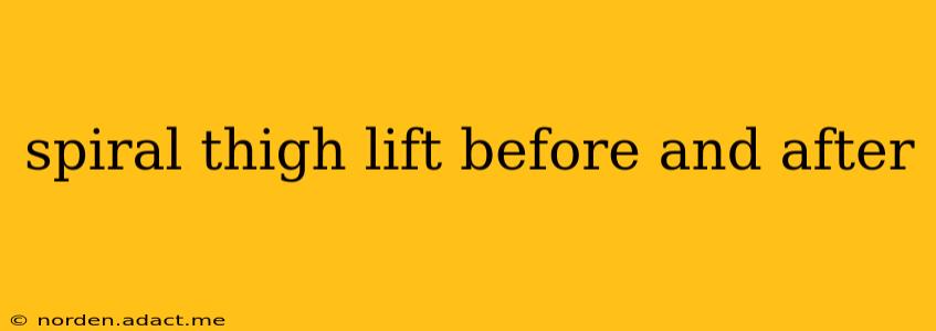 spiral thigh lift before and after