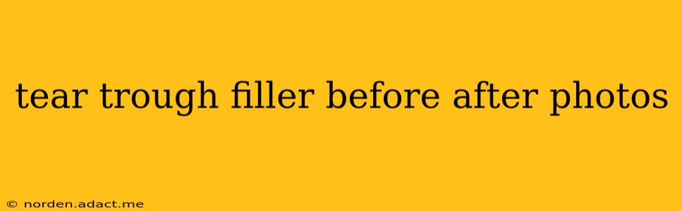 tear trough filler before after photos
