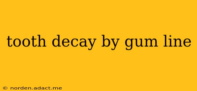 tooth decay by gum line
