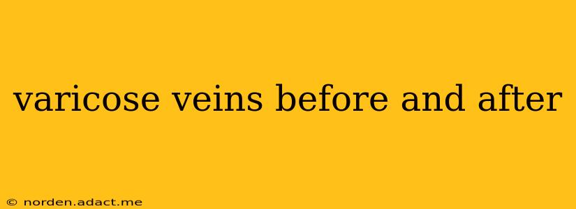 varicose veins before and after