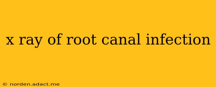 x ray of root canal infection